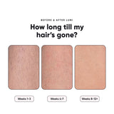 NEW Rose Skin Lumi Laser Hair Removal Device