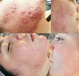 SQT Bio Microneedling for Pigmentation and Acne