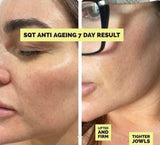 SQT Bio Microneedling - ANTI-AGING. The natural alternative to Botox and Injectables