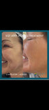 SQT Bio Microneedling - ANTI-AGING. The natural alternative to Botox and Injectables