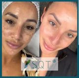 SQT Bio Microneedling for Pigmentation and Acne
