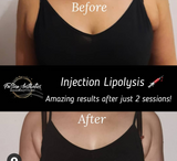 Lipogon CryoCurve Fat Freezing Mesotherapy