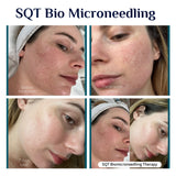 SQT Bio Microneedling for Pigmentation and Acne