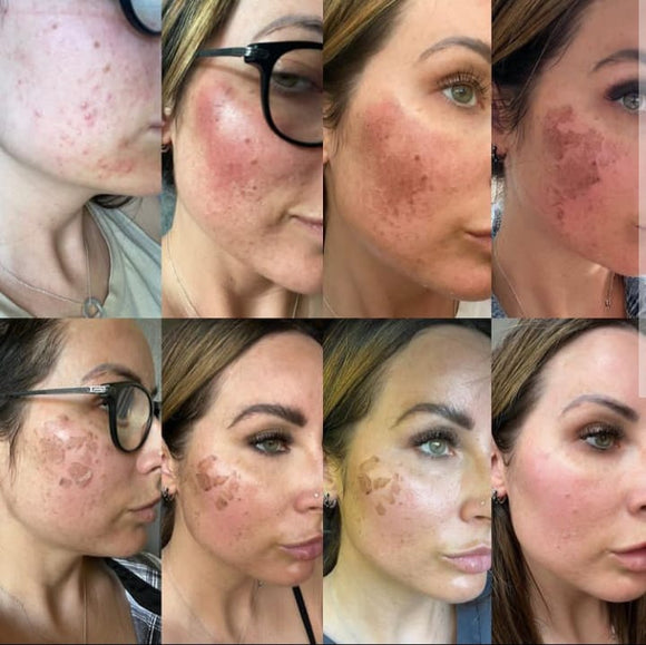 SQT Bio Microneedling for Pigmentation and Acne