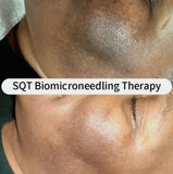 SQT Bio Microneedling for Pigmentation and Acne