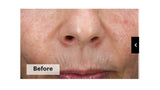 Skinretin Xpert With Exosomes