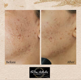 SQT Bio Microneedling - ANTI-AGING. The natural alternative to Botox and Injectables (IN-CLINIC)