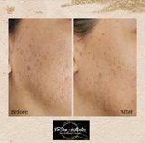 SQT Bio Microneedling - ANTI-AGING. The natural alternative to Botox and Injectables (IN-CLINIC)