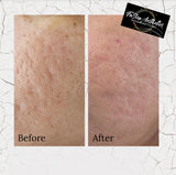 SQT Bio Microneedling - ANTI-AGING. The natural alternative to Botox and Injectables (IN-CLINIC)