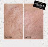 SQT Bio Microneedling - ANTI-AGING. The natural alternative to Botox and Injectables (IN-CLINIC)