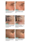 Mesoéclat® Anti-Wrinkle GLOW Treatment