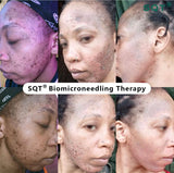 SQT Bio Microneedling for Pigmentation and Acne